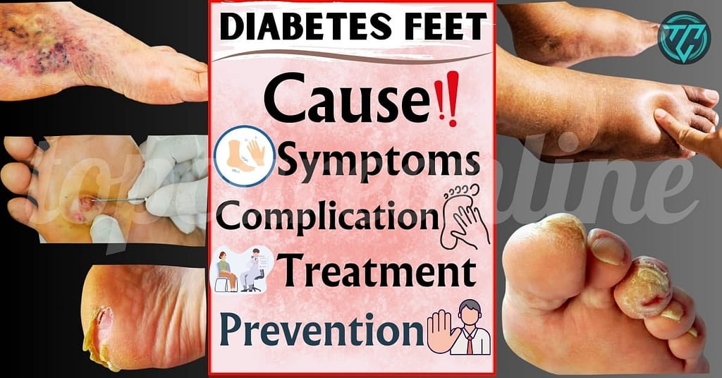 Diabetes Feet Cause, Symptoms, Complication, Treatment, Prevention