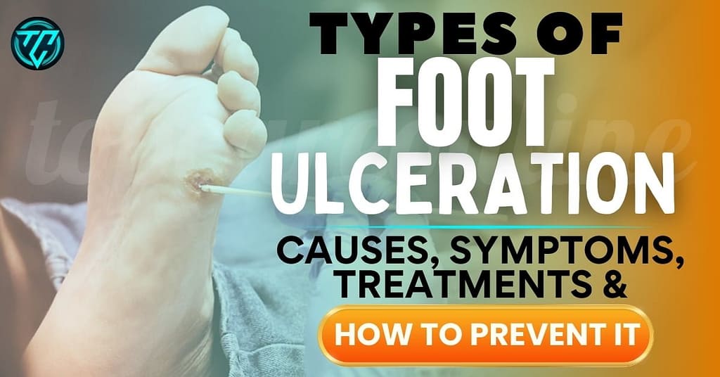 Foot Ulceration