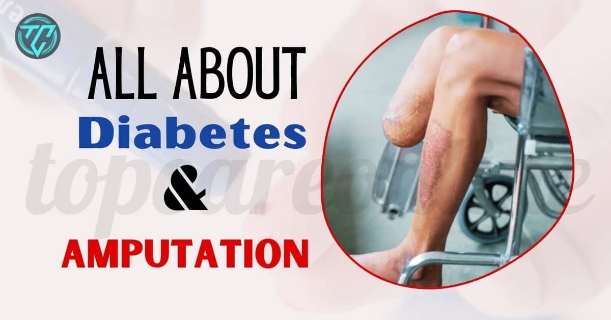 All About Diabetes And Amputation