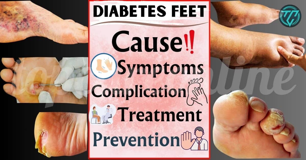 Diabetes Feet : Cause, Symptoms, Complication, Treatment, Prevention